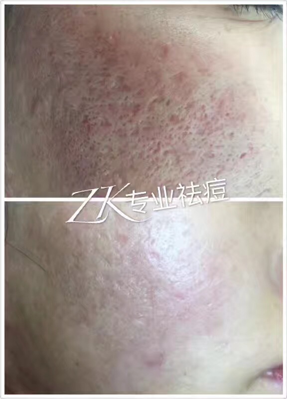 专业祛痘 Z&K Acne Treatment Center | 5440 Yonge St, North York, ON M2N 5R8, Canada | Phone: (647) 646-8888