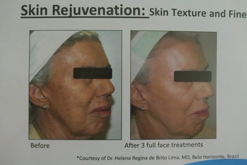 Advanced Laser Hair Removal | 2063 146 Ave SE, Calgary, AB T2J 6C3, Canada | Phone: (587) 777-0323