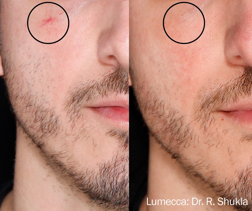 Elan Laser Aesthetics | 2258 Belmont Ct, Burlington, ON L7P 3N3, Canada | Phone: (905) 220-2258