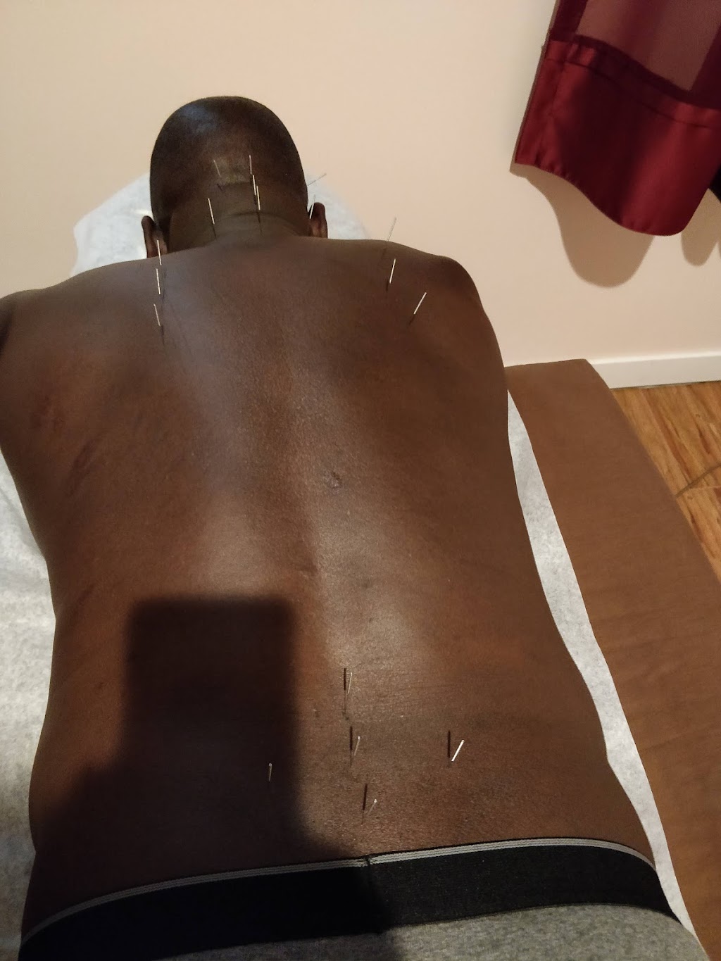 Acupuncture in Hamptons | 10109 Hamptons Blvd NW, Calgary, AB T3A 5A8, Canada | Phone: (403) 993-3202
