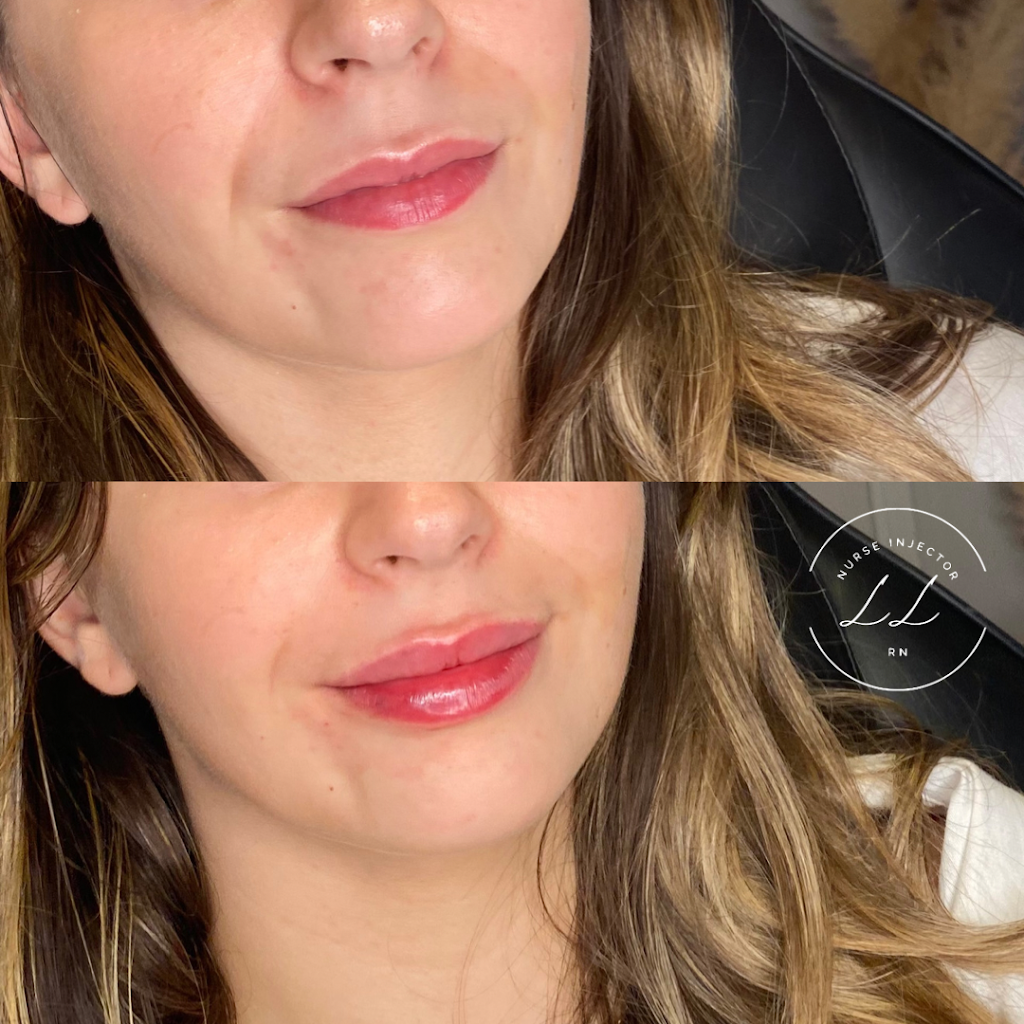 Lauren Landry RN - Halifax Injector: Botox and Dermal Fillers | 6461 Quinpool Rd, Halifax, NS B3L 1B1, Canada | Phone: (902) 789-1174