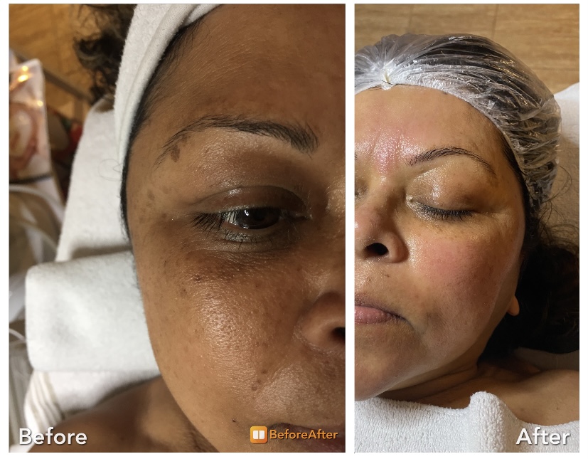 NR Laser & Spa | 7088 Justine Dr, Mississauga, ON L4T 1M3, Canada | Phone: (647) 269-1045