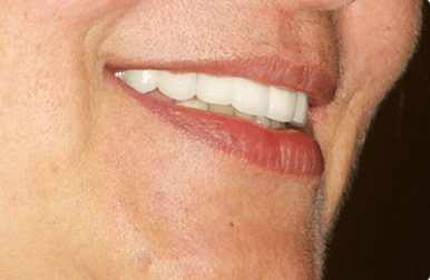 Smile Dental Implant Center - White Rock Dentists & Dental Implants | 1959 152 St, Surrey, BC V4A 9E3, Canada | Phone: (604) 531-3344