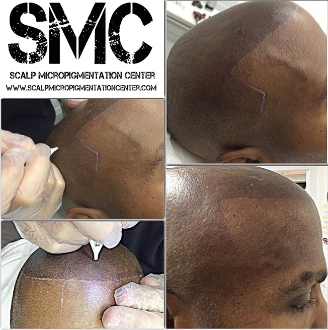 Scalp Micropigmentation Training Center Head Office | 19 Aerodrome Crescent #301, East York, ON M4G 4J3, Canada | Phone: (844) 877-2257