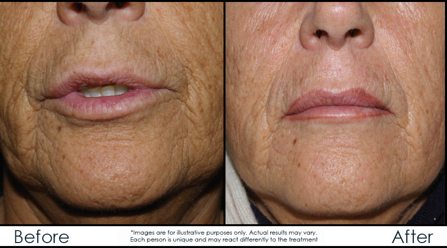 Infinium Médecine Esthétique | 729 Boulevard Saint-Joseph, Gatineau, QC J8Y 4B6, Canada | Phone: (819) 771-4284