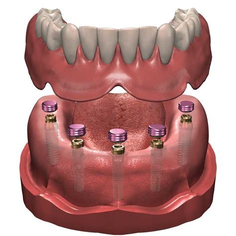 Denturologiste Rivière Rouge | 716 Rue LAnnonciation N Suite 202, Rivière-Rouge, QC J0T 1T0, Canada | Phone: (819) 275-2418