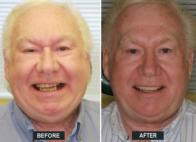 Bracebridge Denture Clinic | Archdekin Medical Building, 205 Hiram St, Bracebridge, ON P1L 2C1, Canada | Phone: (705) 646-0504