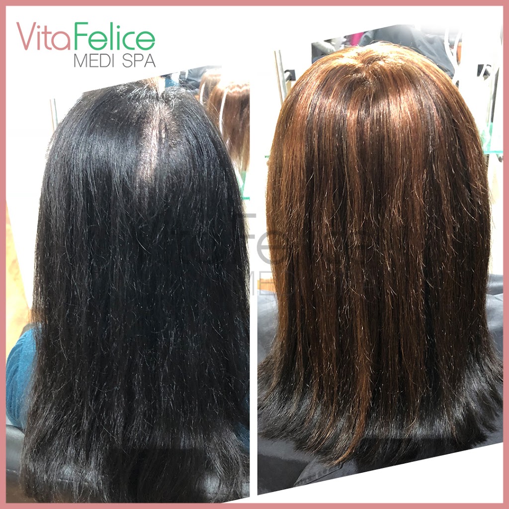 Vita Felice Medi Spa | 661 Columbia St, Unit 103, New Westminster, BC V3M 1A8, Canada | Phone: (778) 987-5480