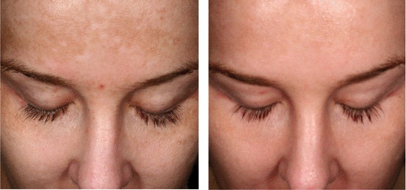 YS Canadian Laser Spa | 3201 Yonge St, Toronto, ON M4N 2K9, Canada | Phone: (416) 481-3032