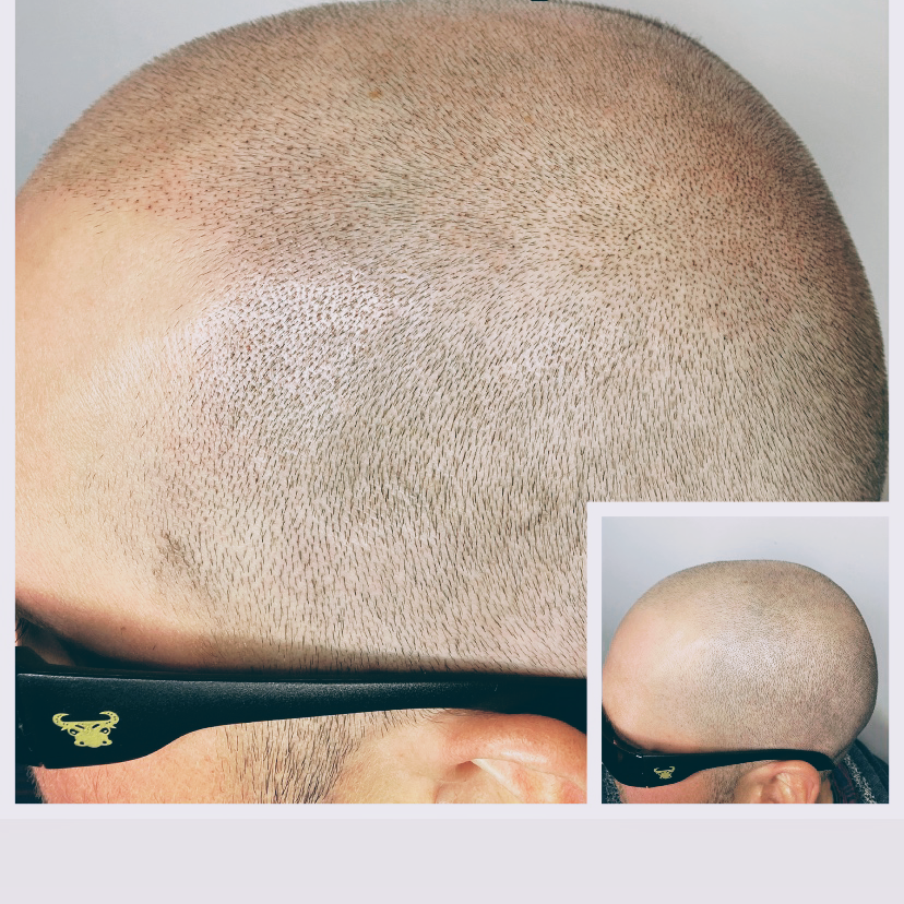Royal Scalp and Brows - Scalp Micropigmentation and Microblading | 22366 Dewdney Trunk Rd, Maple Ridge, BC V2X 3J2, Canada | Phone: (778) 888-1557