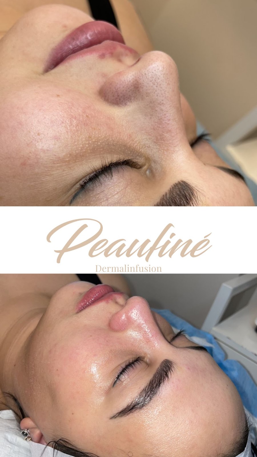 Clinique Peaufiné - Esthétique & Laser | 50 Chem. de la Carrière, Carignan, QC 106, Canada | Phone: (450) 876-0401