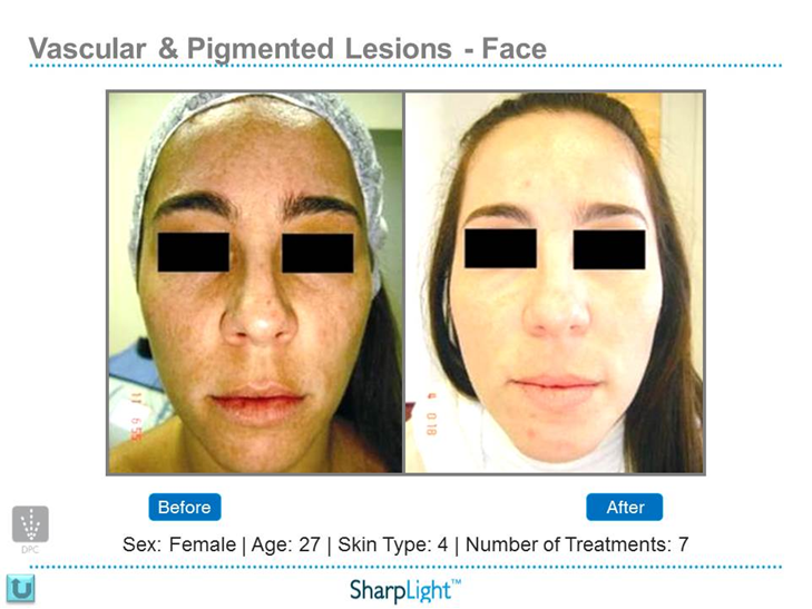 Refresh Laser & Skin Rejuvenation | 901 Heritage Dr SW, Calgary, AB T2V 2W8, Canada | Phone: (403) 464-9417
