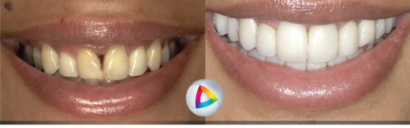Compleo at Dentistry At Vitality Health | East, 4792 Hwy 7, Unionville, ON L3R 1M8, Canada | Phone: (647) 993-4792