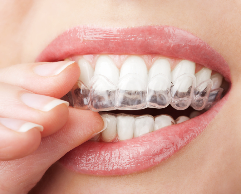 Bayshore Dental Centre | 3029 Carling Ave suite 101, Ottawa, ON K2B 8E8, Canada | Phone: (613) 680-8090