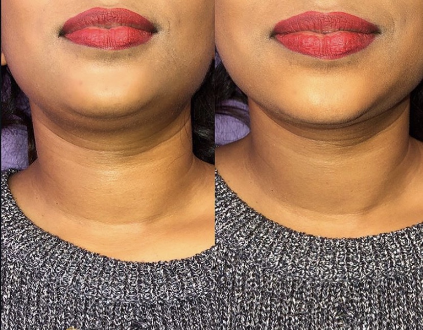 Body Perfection | 36 Tynevale Dr, Etobicoke, ON M9R 2B5, Canada | Phone: (647) 523-4526