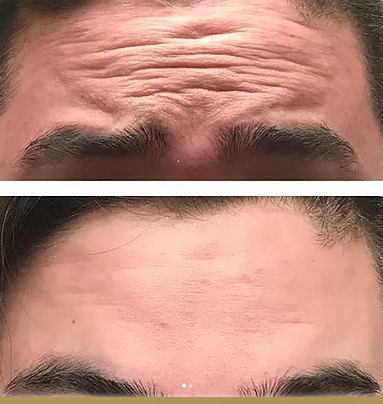 Bella Vita Injectables | 1169 Garner Rd E, Ancaster, ON L9G 3K9, Canada | Phone: (905) 327-2478