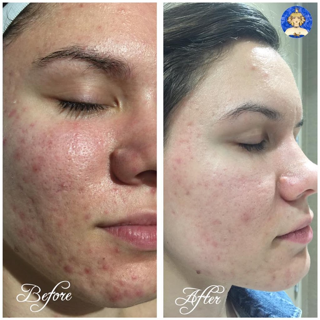 Innana Laser Clinic | 6 Worthington Pl, Bedford, NS B4A 0C5, Canada | Phone: (902) 835-6871