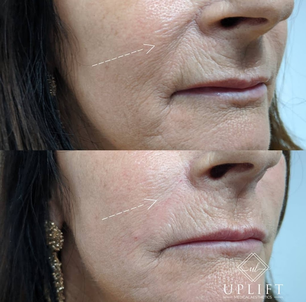 Uplift Medical Aesthetics | 2022 Main St N, Jarvis, ON N0A 1J0, Canada | Phone: (519) 420-9225