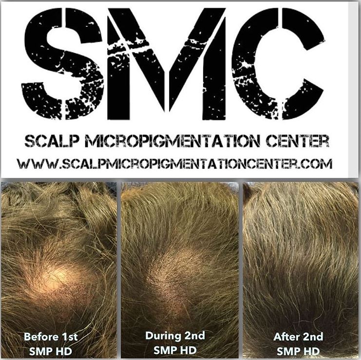 Scalp Micropigmentation London | 328 Glenrose Dr, London, ON N6K 2A8, Canada | Phone: (519) 881-6044