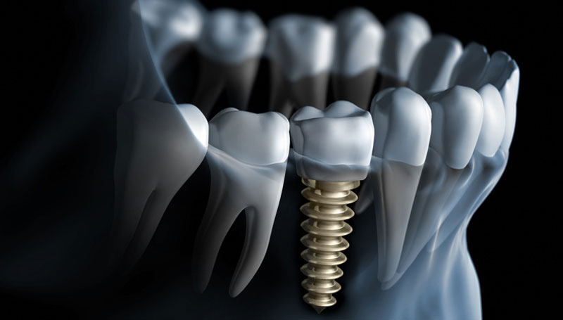 Souris Family Dental | 1905 1 Ave NE, Weyburn, SK S4H 0A1, Canada | Phone: (306) 842-8111