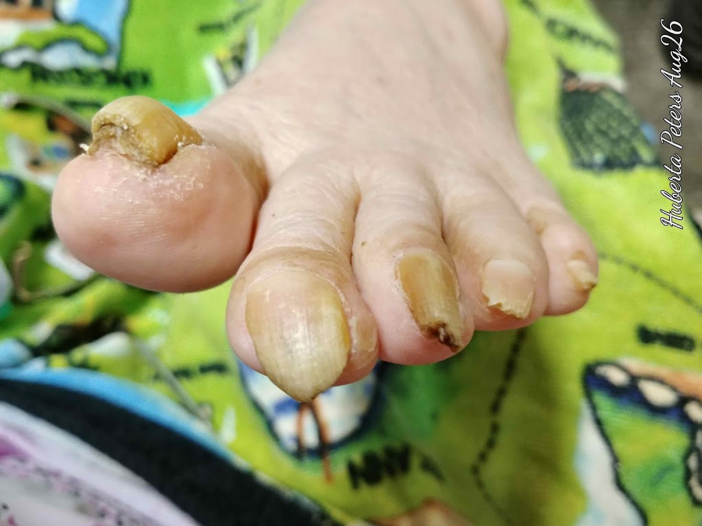 Healthy Feet Mobile Foot Care Services | Gough Ave, London, ON N5X 4P8, Canada | Phone: (519) 933-9155