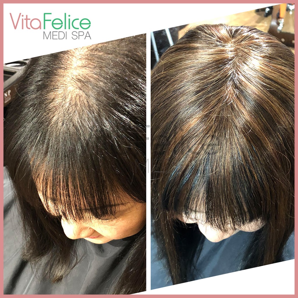 Vita Felice Medi Spa | 661 Columbia St, Unit 103, New Westminster, BC V3M 1A8, Canada | Phone: (778) 987-5480