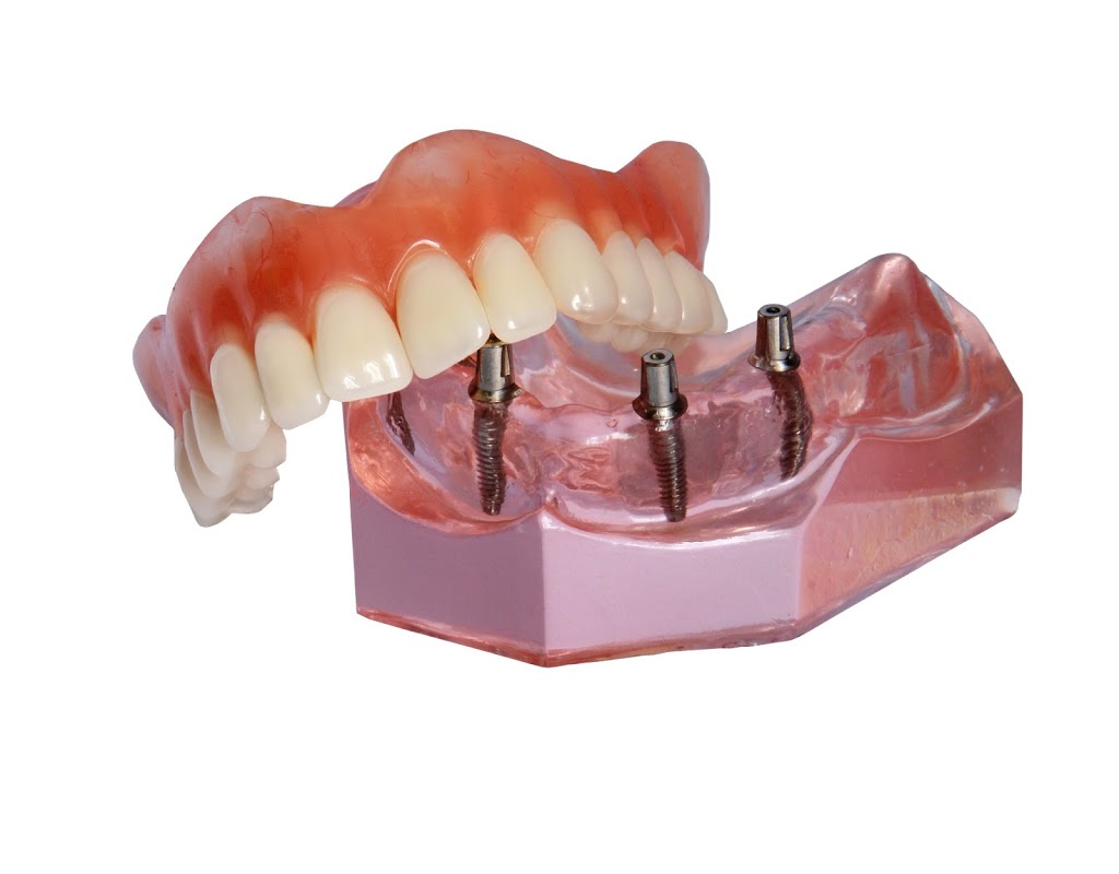 Dental & Implant Centre, Dr Cantillo | 1436 Royal York Rd Suite #301, Etobicoke, ON M9P 3A9, Canada | Phone: (416) 562-1195