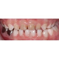 Primary Care Pediatric Dentistry | 6424 200 St #102, Langley City, BC V2Y 2T3, Canada | Phone: (604) 427-1010