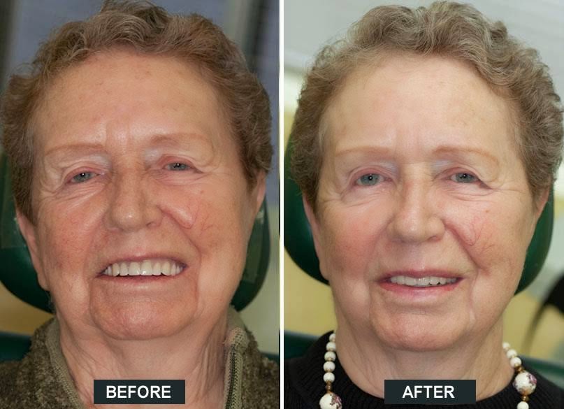 Bracebridge Denture Clinic | Archdekin Medical Building, 205 Hiram St, Bracebridge, ON P1L 2C1, Canada | Phone: (705) 646-0504