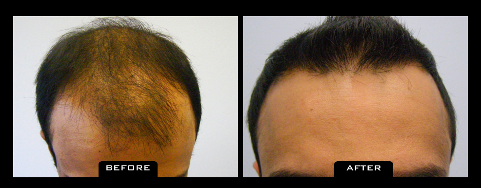 NuHair Medical Hair Transplant Centre | 4040 Veterans Pl NW Unit 200, Calgary, AB T3B 3R7, Canada | Phone: (403) 923-5954