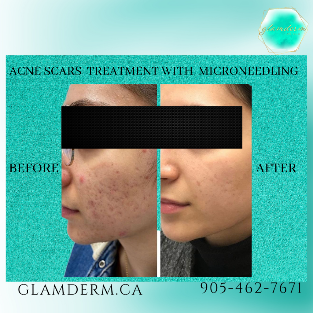 Glamderm Med Spa | 32 Village Centre Pl Suite 103 &104, Mississauga, ON L4Z 1V9, Canada | Phone: (905) 462-7671