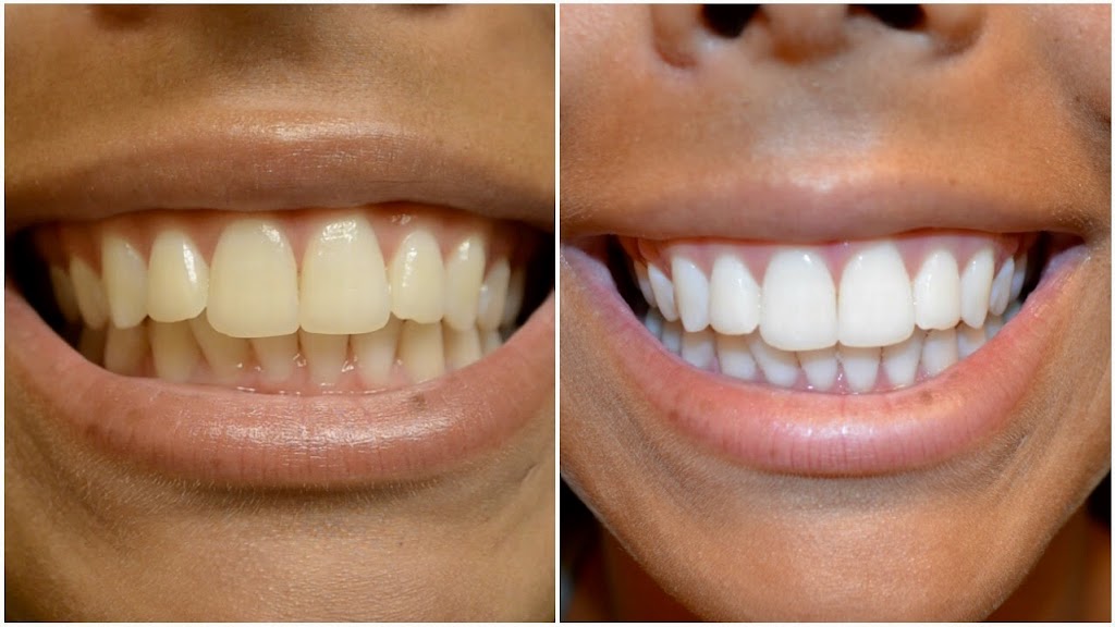 Blanchiment Dentaire rive-sud | 87 suite D, Rue St Pierre, Saint-Constant, QC J5A 1G7, Canada | Phone: (514) 730-8423
