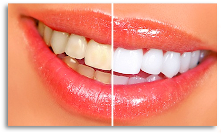 Blue Sky Dental Clinic | 742 Marine Dr, North Vancouver, BC V7M 1H3, Canada | Phone: (604) 971-6999