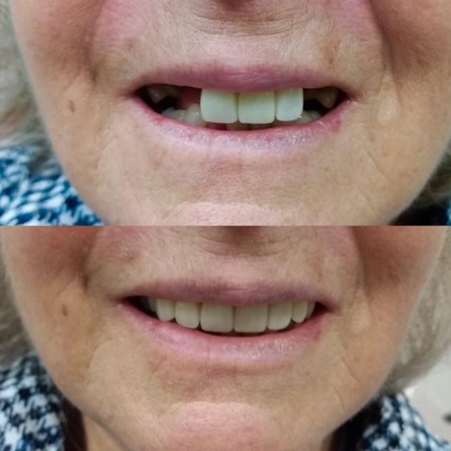 Ottawa South Denture Clinic | 2210 Prince of Wales Dr #701, Nepean, ON K2E 6Z9, Canada | Phone: (613) 695-9229