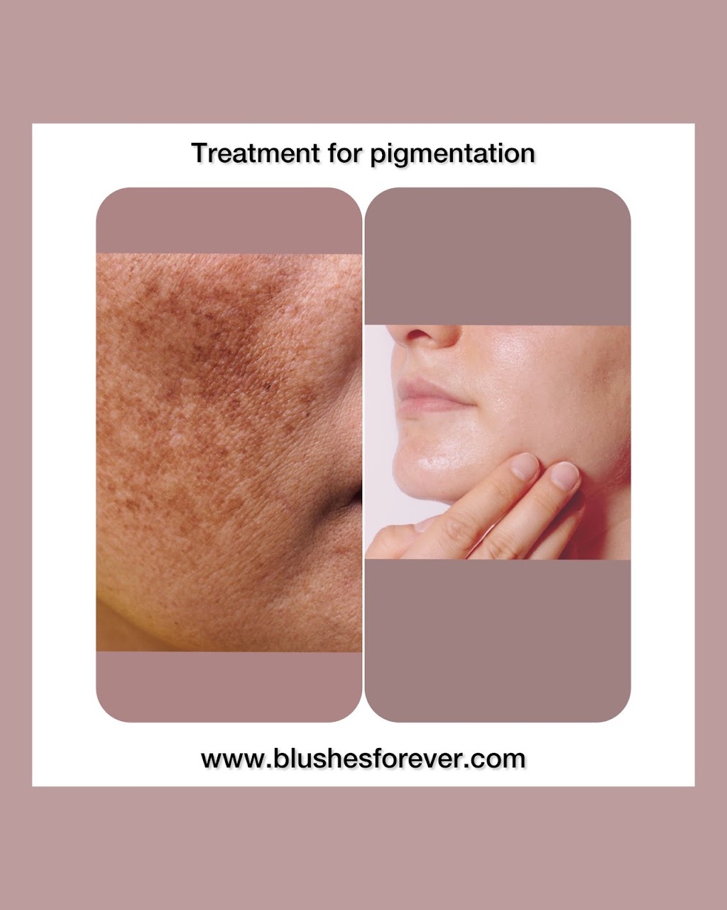 Blushes Forever Skin Care | H11C, 260300 Writing Creek Cres, Balzac, AB T4A 0X8, Canada | Phone: (825) 365-1610