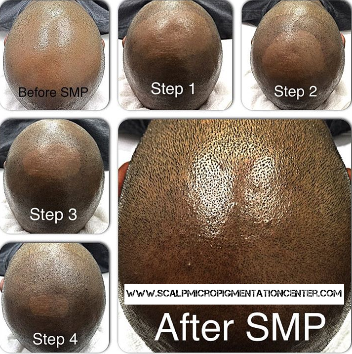 Scalp Micropigmentation Training Center Head Office | 19 Aerodrome Crescent #301, East York, ON M4G 4J3, Canada | Phone: (844) 877-2257