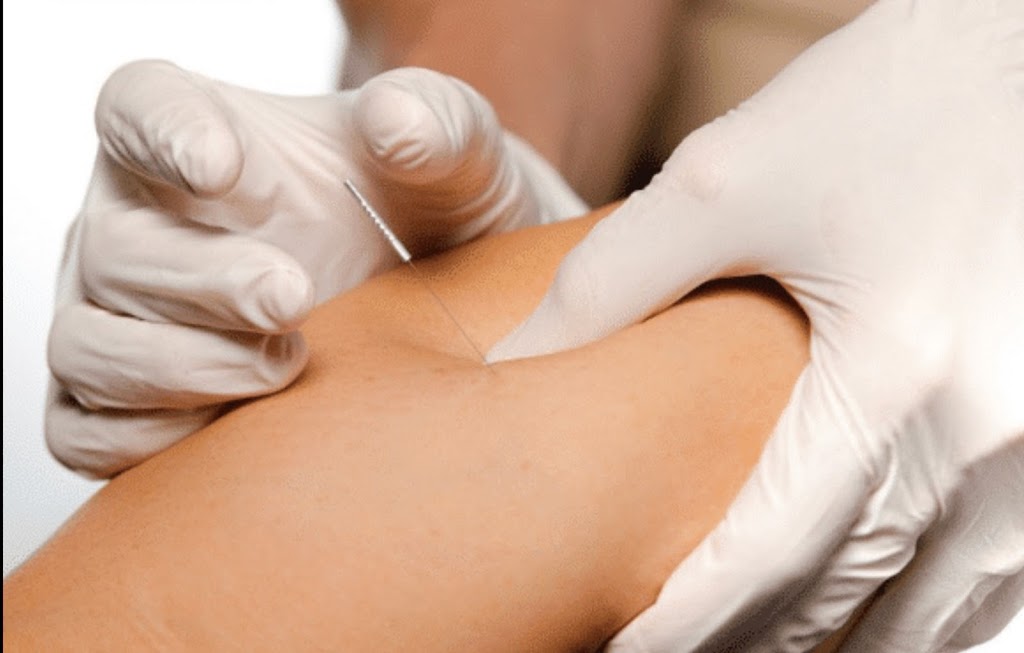 Acupuncture CNESST / SAAQ | 2451 4e Rang S, Mont-Saint-Hilaire, QC J0H 2G0, Canada | Phone: (514) 863-9387