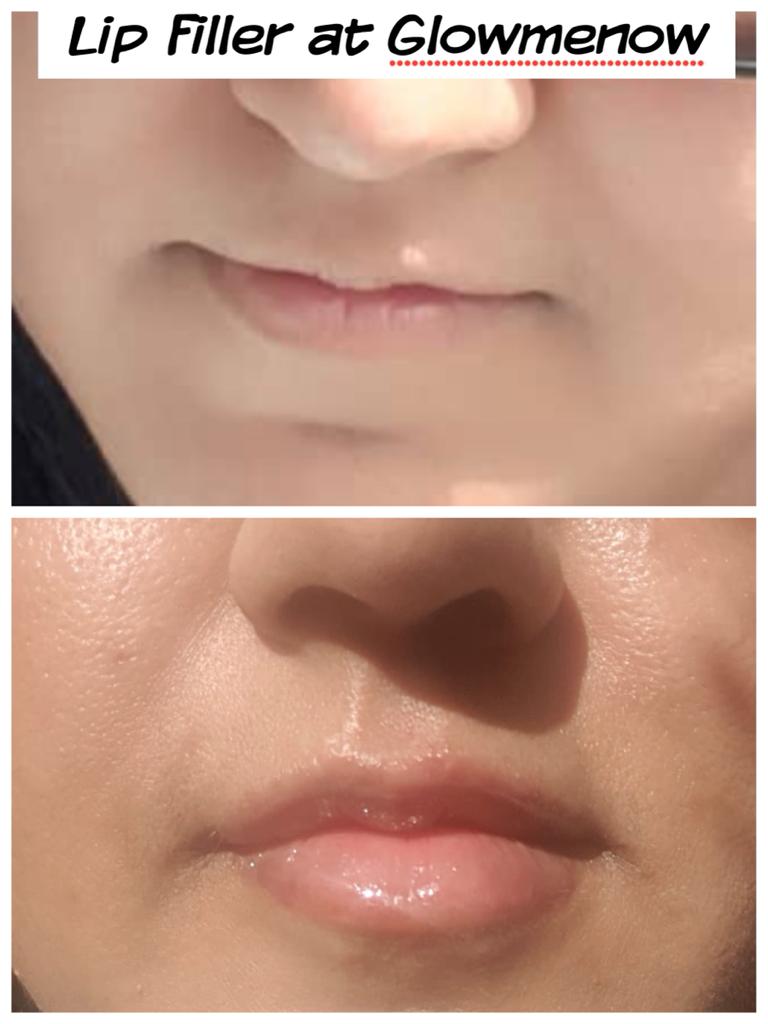 Glow Me Now Aesthetic Lounge & Medi Spa | 1199 Alberni Rd, Woodstock, ON N4T 0H9, Canada | Phone: (647) 767-3349
