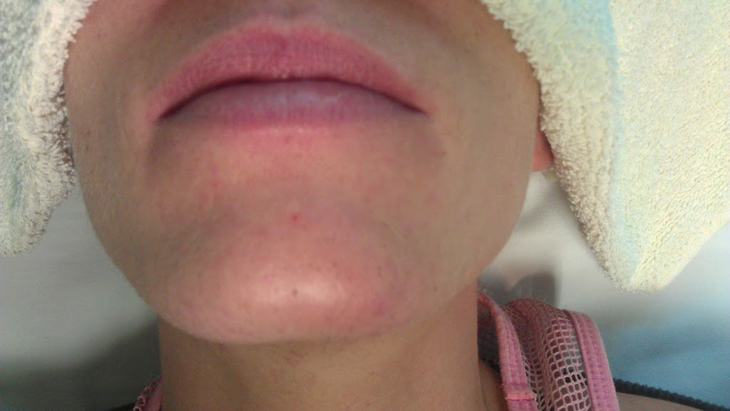 Caldwell Place Clinic~Electrolysis | 37 Caldwell Rd, Cole Harbour, NS B2V 1A2, Canada | Phone: (902) 462-3362