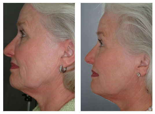 Skin Care Lazer YXE | Sunsera Salon. Ask for Olga (Laser technician, 815 Gray Ave, Saskatoon, SK S7N 2K6, Canada | Phone: (639) 318-9969