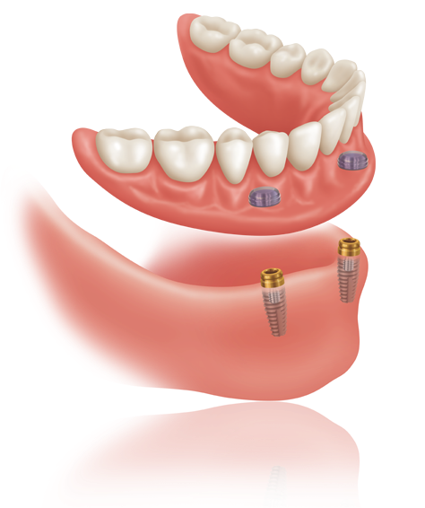 Denturologiste Boisbriand | 574 Bd du Curé-Labelle Bureau 203, Blainville, QC J7P 2H8, Canada | Phone: (514) 506-4983