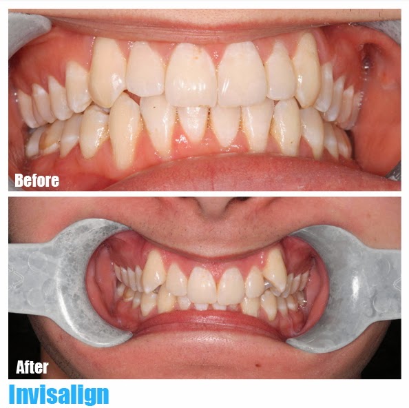 Simon Fraser Dental Centre | 8960 University High St #140, Burnaby, BC V5A 4Y6, Canada | Phone: (604) 267-3368