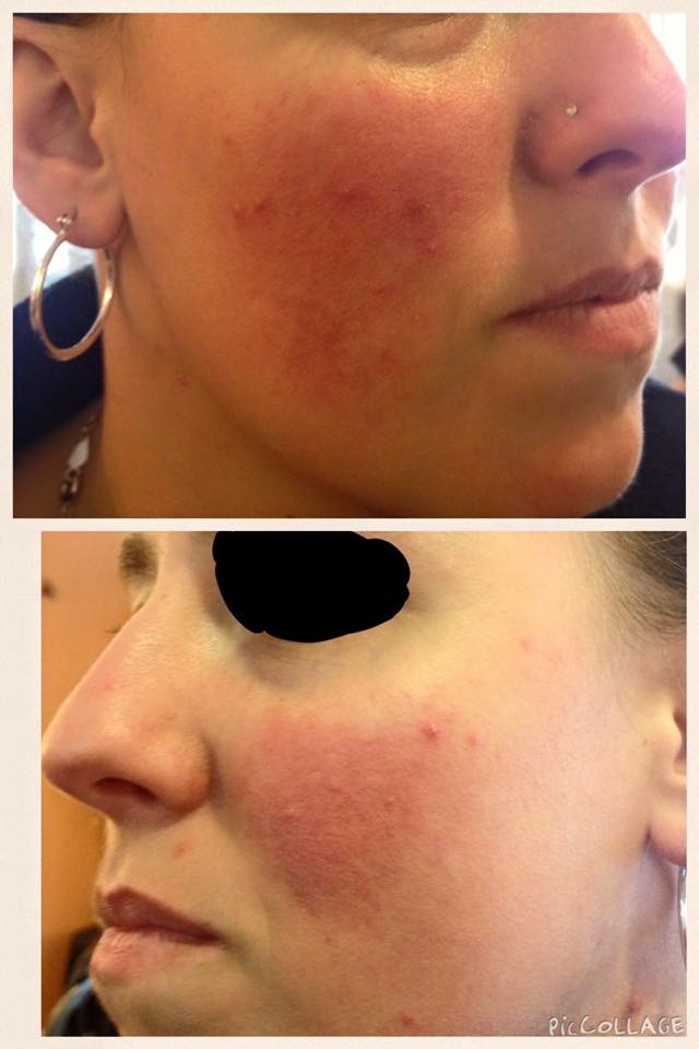 Sirenas Esthetic And Laser Clinic | 83 Pheasant Run Dr, Nepean, ON K2J 2R3, Canada | Phone: (613) 825-3003