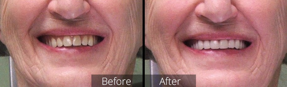 Saanich Walk-in Denture Clinic - Denturist in Victoria | 3581 Shelbourne St #101A, Victoria, BC V8P 4G8, Canada | Phone: (250) 595-1665
