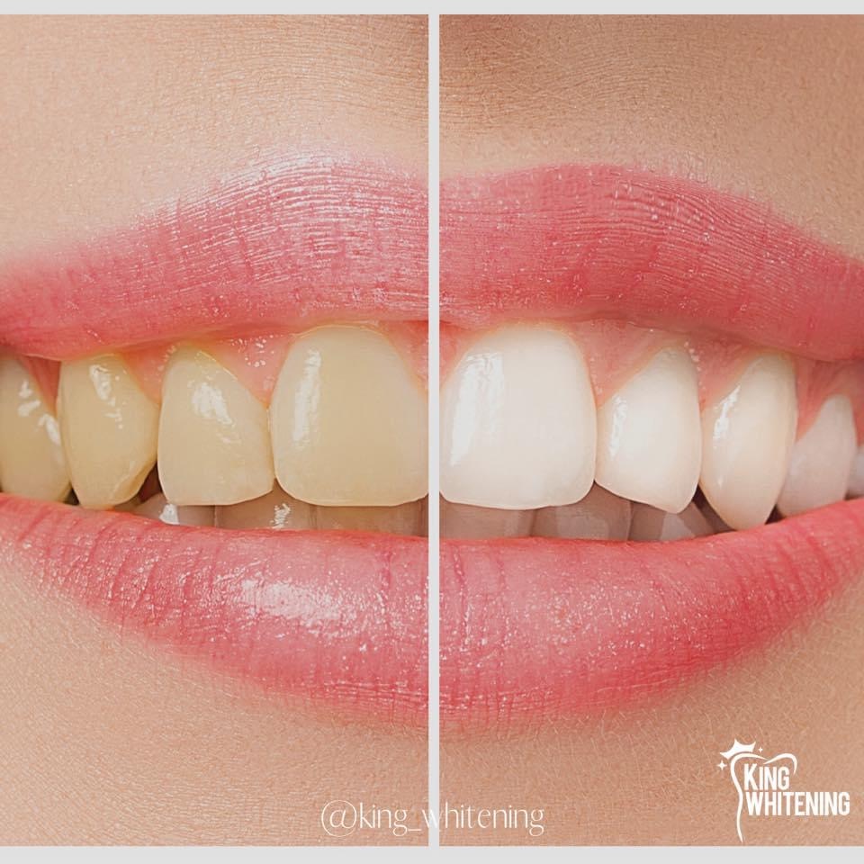 King Whitening | 12 Kingsland Ave, Mulmur, ON L9V 3H1, Canada | Phone: (416) 888-5546