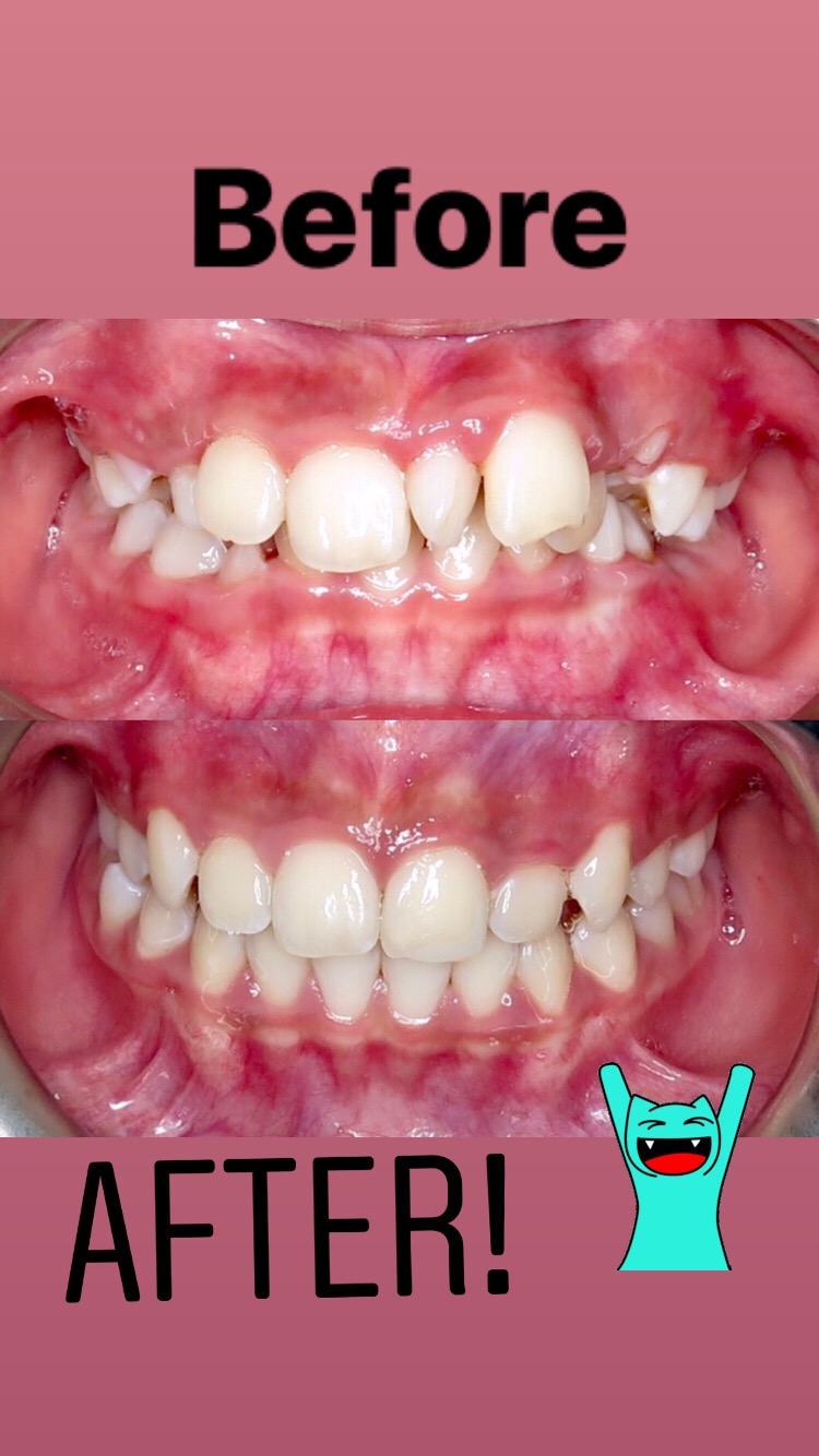 SmileZone Orthodontics | 31 Southridge Dr #151, Okotoks, AB T1S 1V3, Canada | Phone: (587) 757-9440