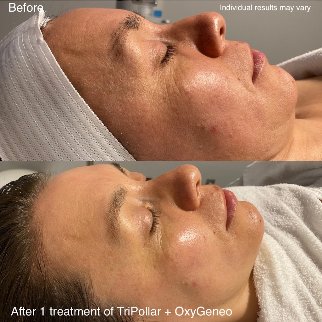 Rosy Derma Clinic | 51 Hawktree Ridge, Nepean, ON K2J 5N7, Canada | Phone: (613) 262-8929