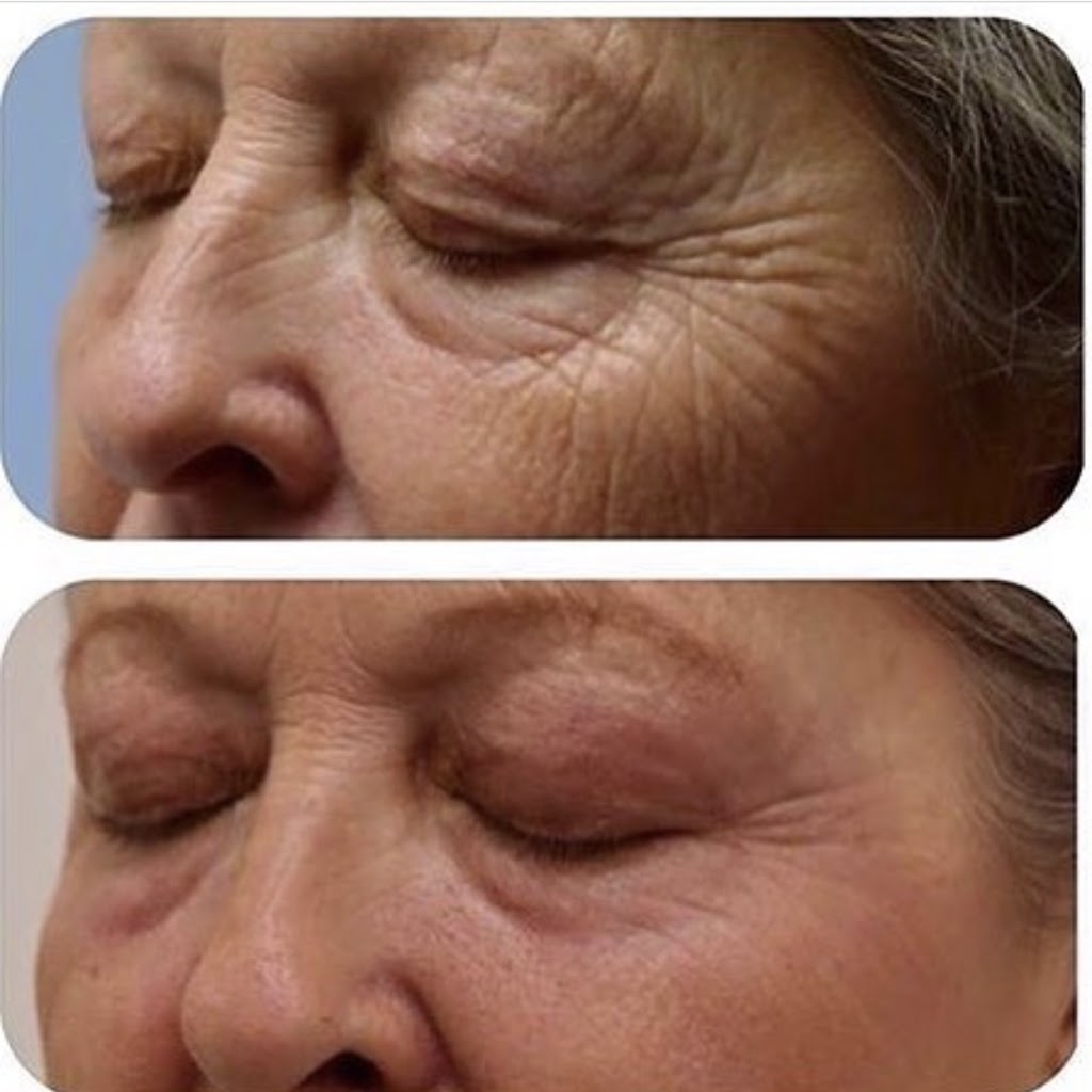 Plasma Skin Regeneration | 00 Ranch Gate, Strathmore, AB T1P 0B4, Canada | Phone: (403) 901-4663