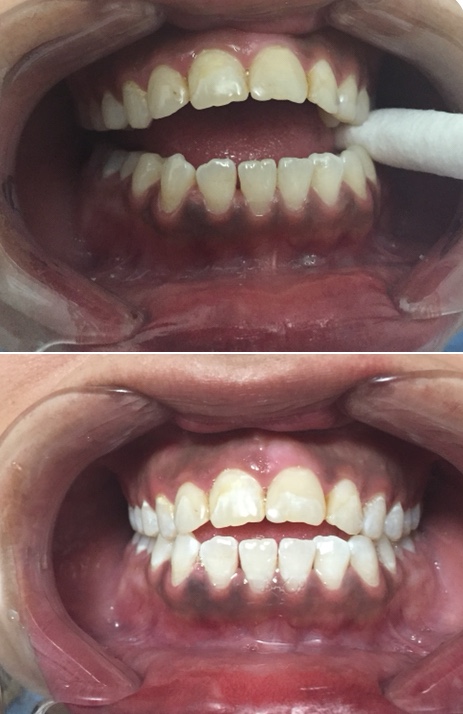 Sensational Smile Whitening | 16748 61 St NW, Edmonton, AB T5Y 0W7, Canada | Phone: (780) 221-6240