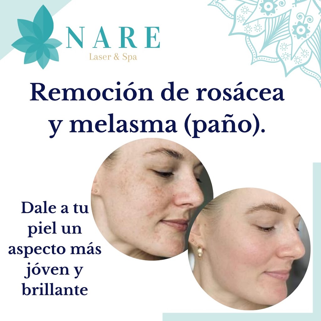 NARE Laser & Spa | 1366 Lawrence Ave W, North York, ON M6L 1A7, Canada | Phone: (416) 697-6375